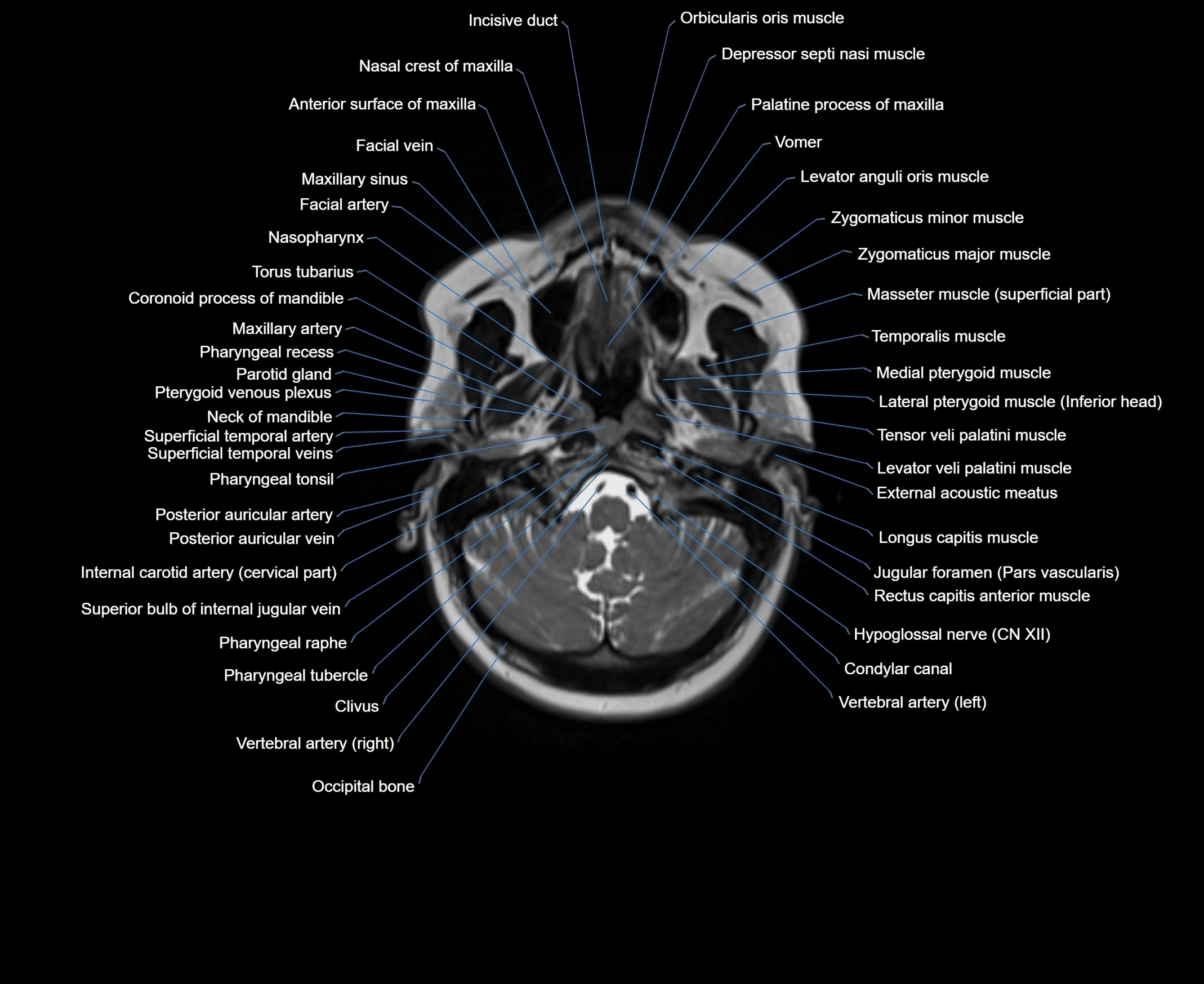 MRI Neck 3D labelled cross section anatomy axial 3t image-00001-00017.webp